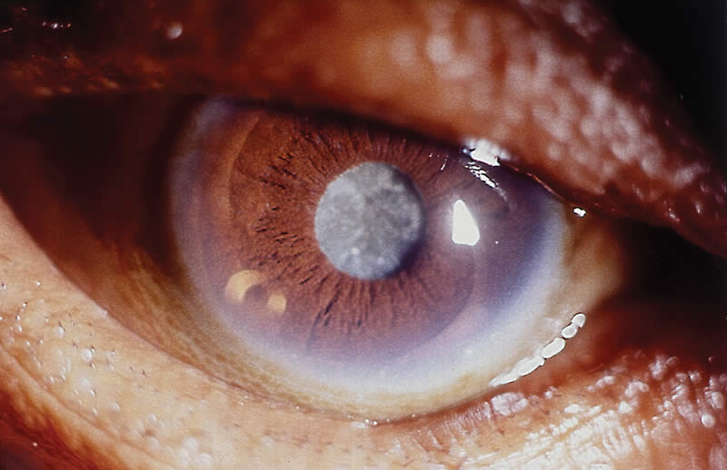 Cataracte : définition et symptômes